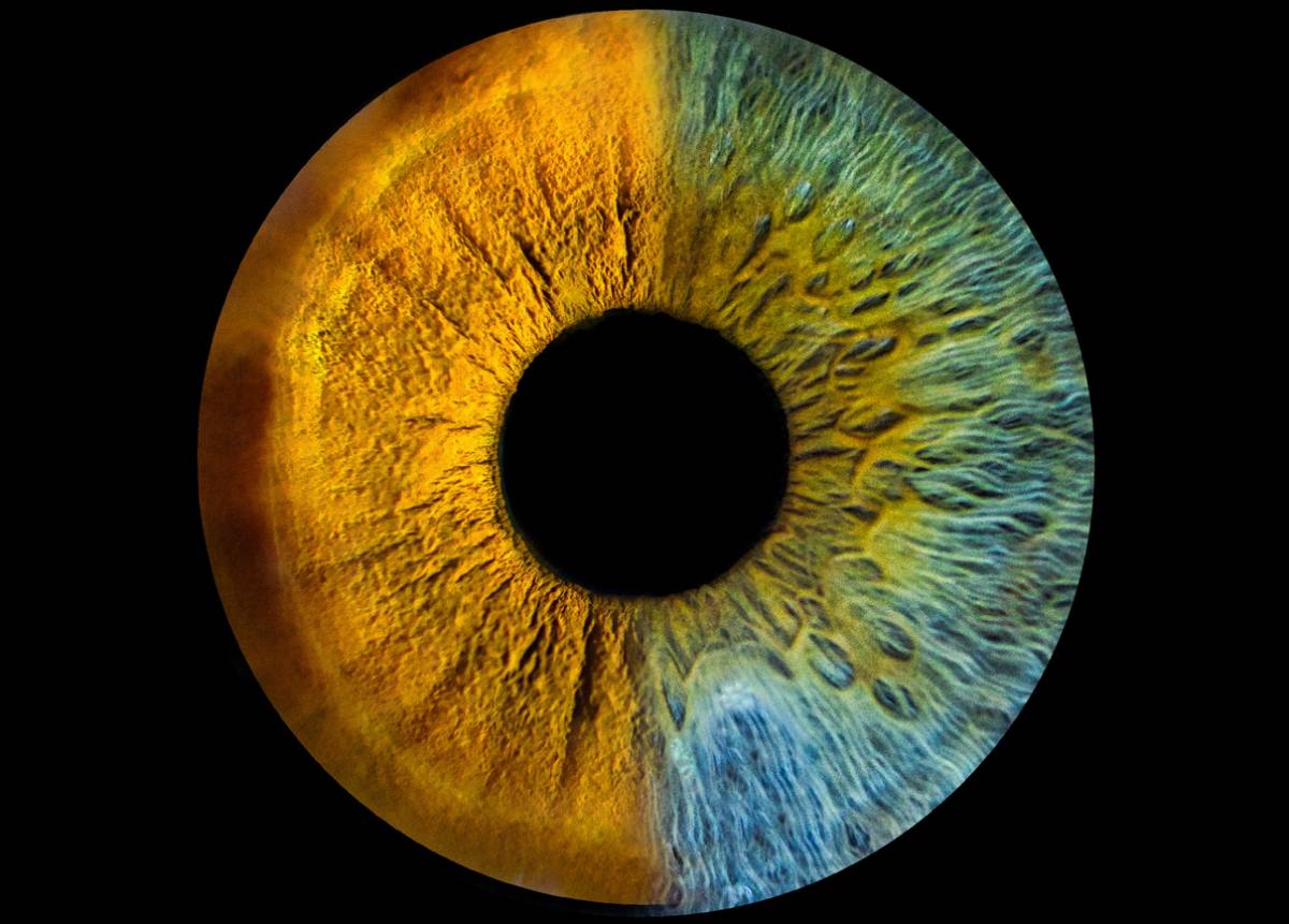 My friend has color outside of the dark ring around his iris, like the  color spilled out a little onto the white of his eye. Is this common? -  Quora