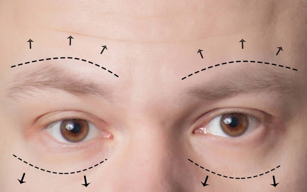 the-types-of-eyelid-surgery-advanced-eye-medical-group