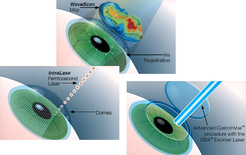 Infographic image that explains VISX Excimer Laser