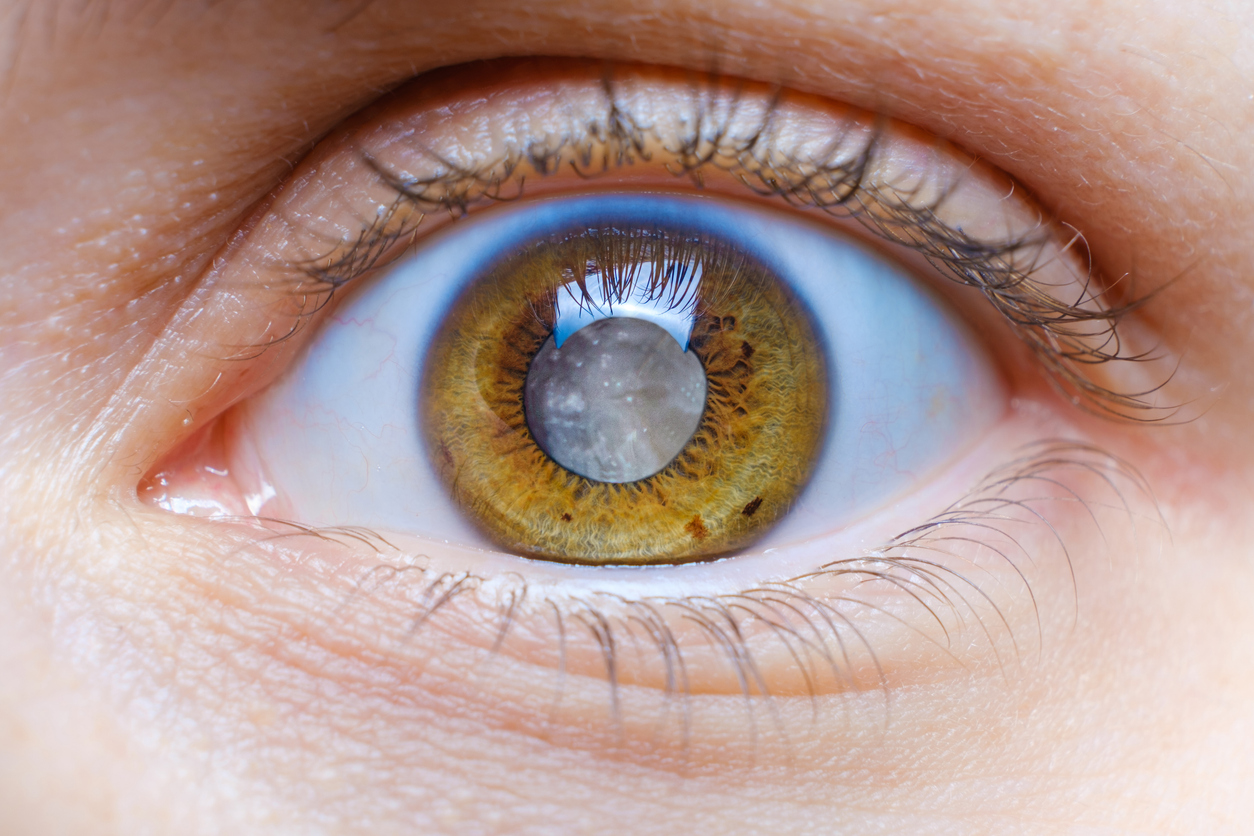 The image shows an eye with severe cataracts to explain the diseases that can cause cataracts.