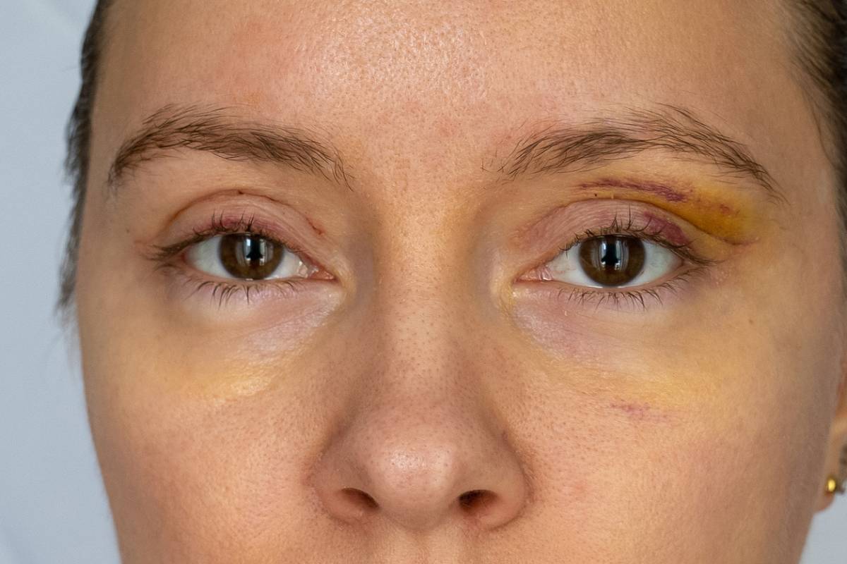 Featured image for How Long Is the Eyelid Surgery Recovery Process